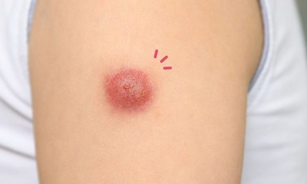 Kondisi Penderita Bisulan Yang Di Alami Seseorang